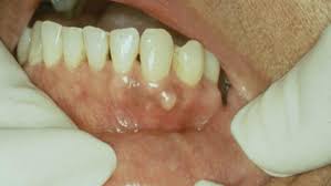 Dentigerous cyst - Hình ảnh minh họa